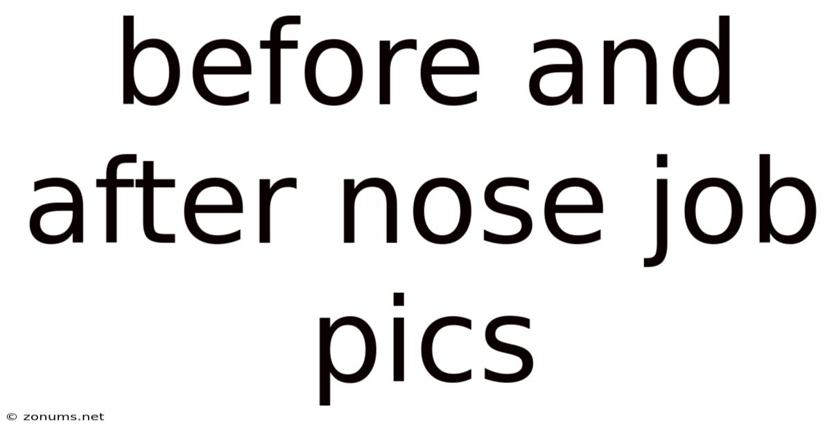 Before And After Nose Job Pics
