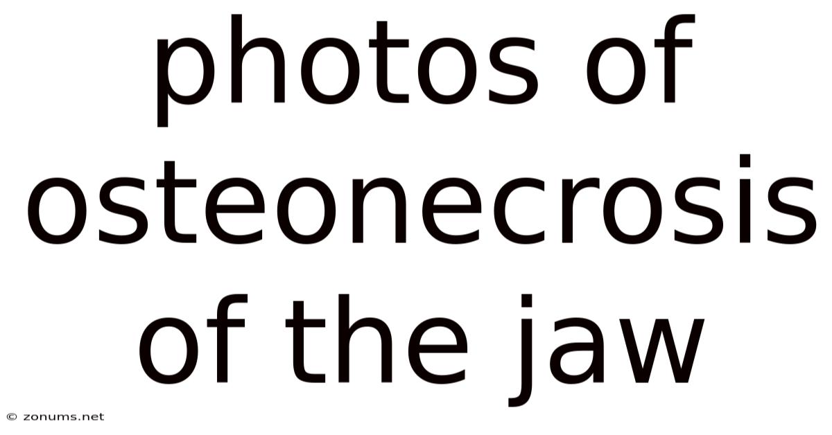 Photos Of Osteonecrosis Of The Jaw