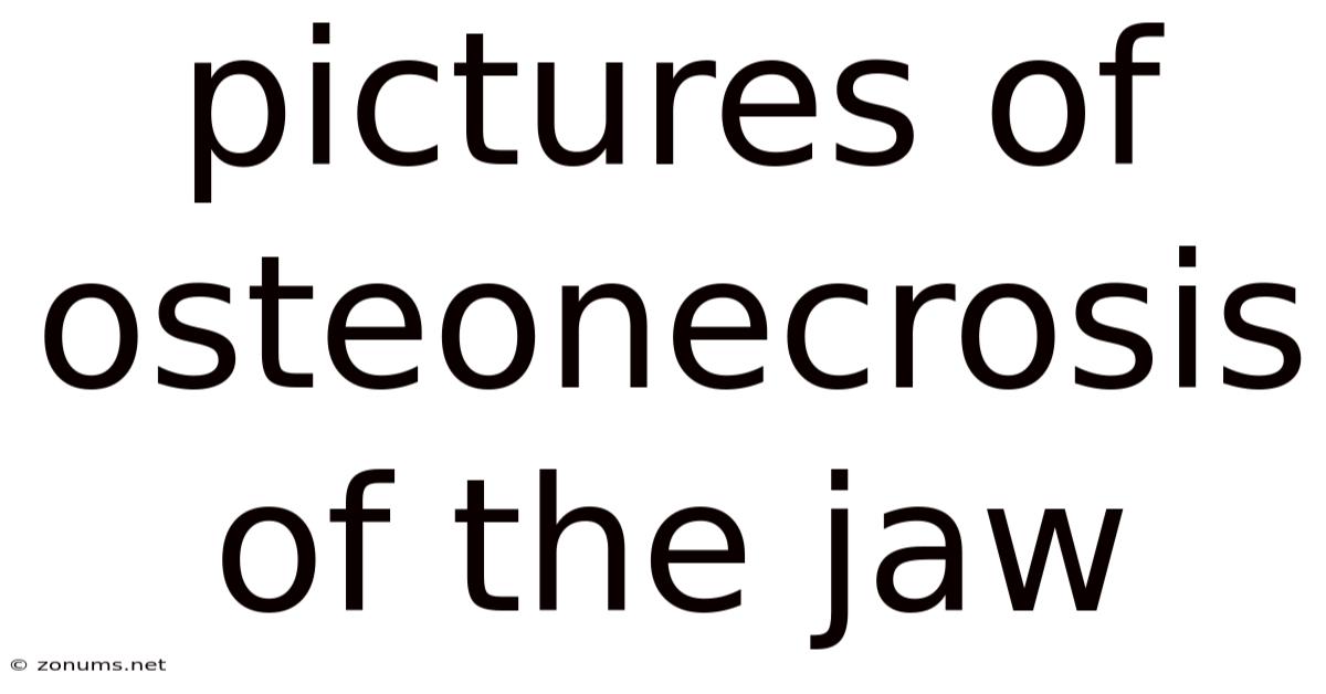Pictures Of Osteonecrosis Of The Jaw